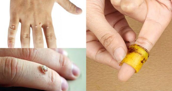 Trị mụn cóc