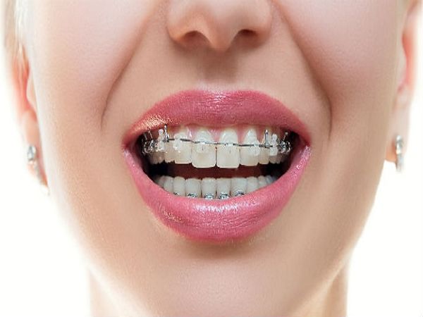 Địa chỉ niềng răng uy tín tphcm nha khoa Minh Thu