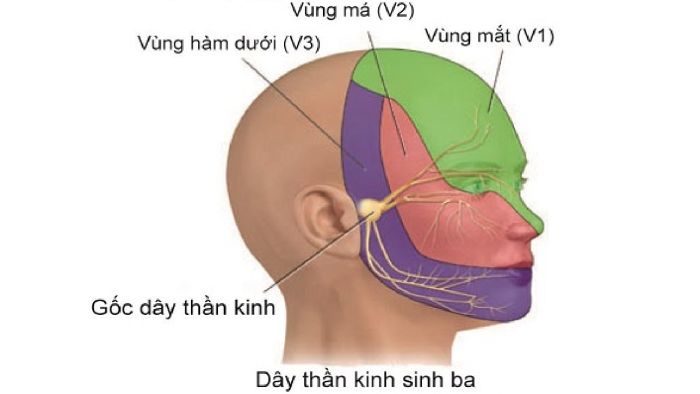Đau dây thần kinh sinh ba