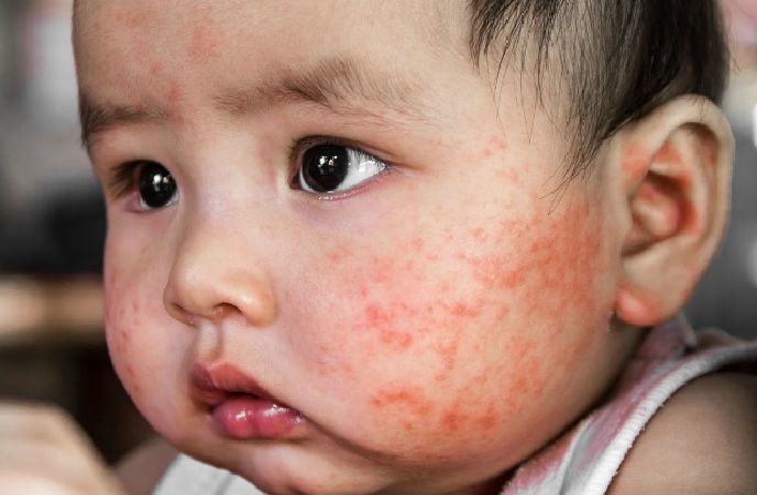 Chàm Eczema