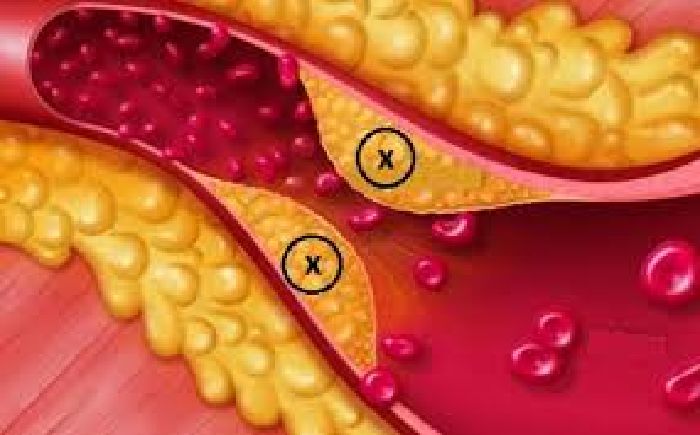 Giảm cholesterol, mỡ máu, tiểu đường