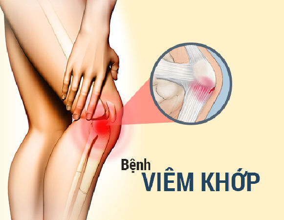 Điều trị viêm khớp