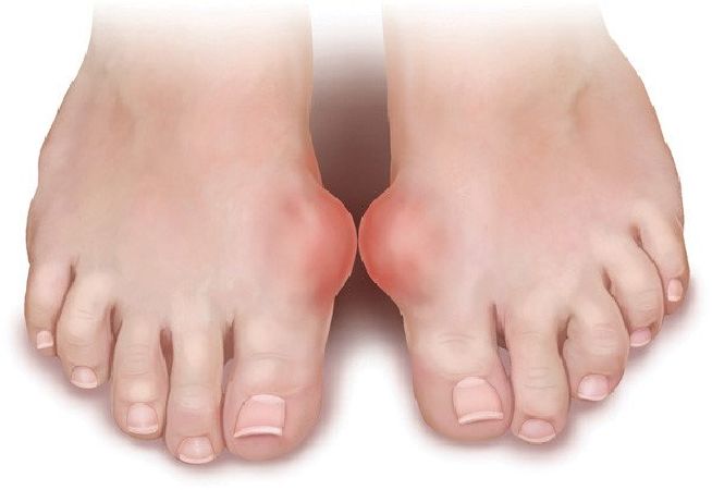 Điều trị bệnh gout