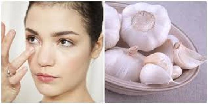 Công dụng của tỏi trị mụn