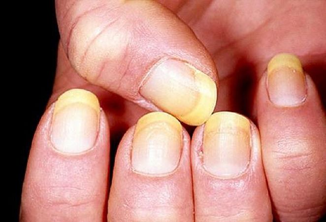 Trị bệnh nấm móng chân nhiễm trùng Tinea