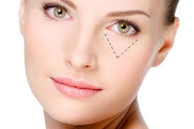 Trị thâm quầng mắt