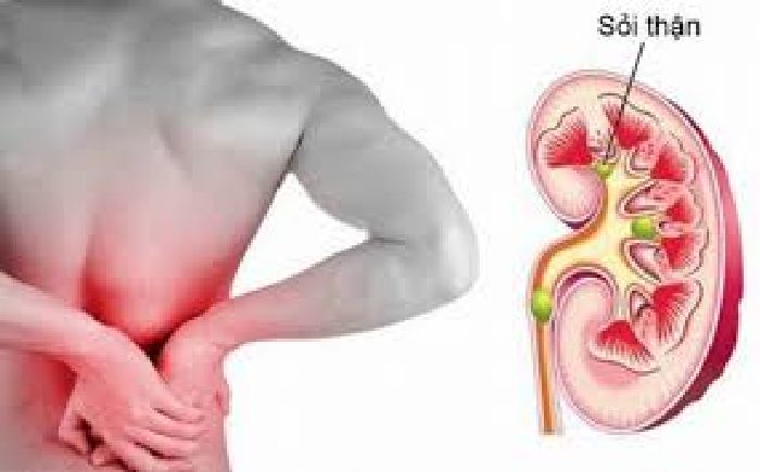 Ngăn ngừa bệnh sỏi thận
