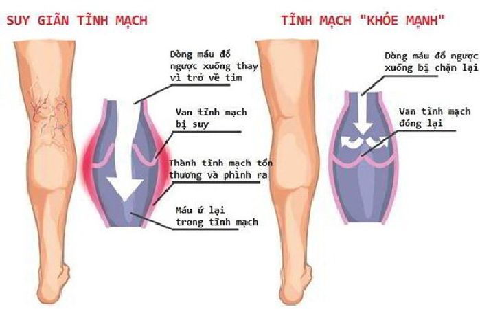 3. Giảm dấu hiệu xuất hiện bệnh suy tĩnh mạch