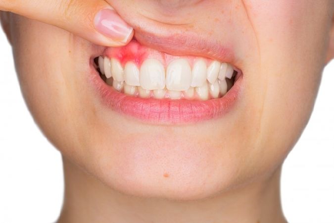 Bệnh sưng chân răng và nhức răng