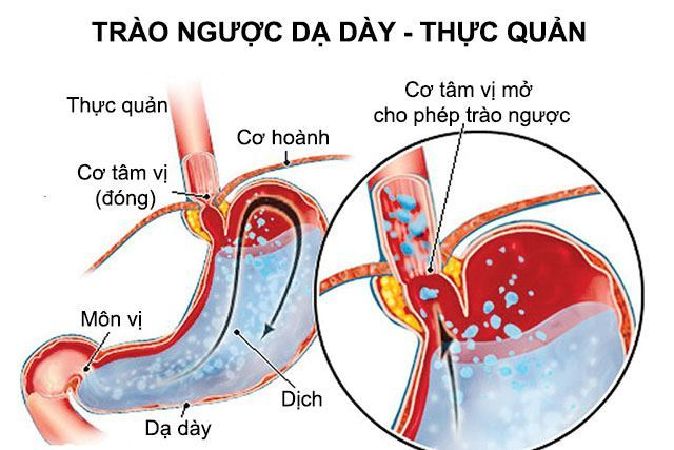 Axit trào ngược