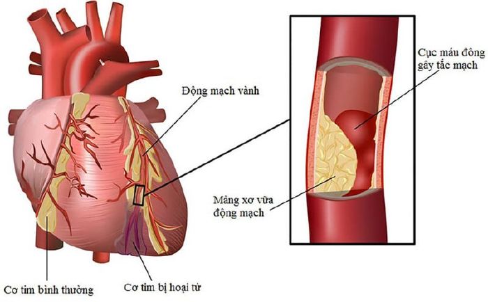 Bệnh tim mạch vành