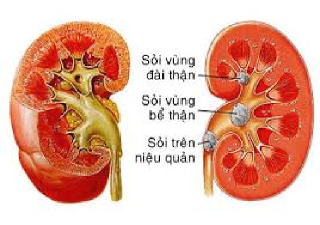 Sỏi đường tiết niệu