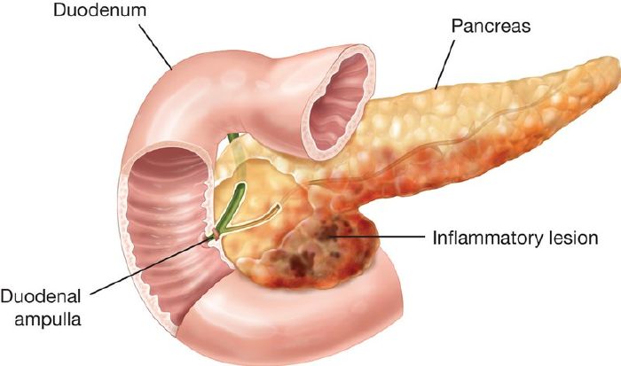 Viêm tụy cấp