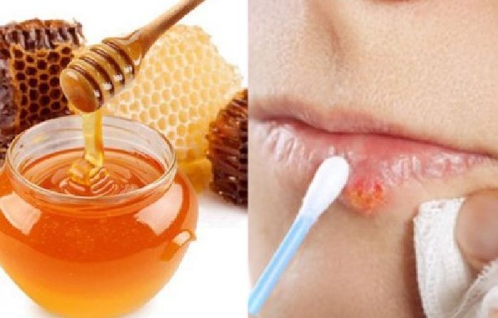 Trị loét miệng tận gốc bằng mật ong