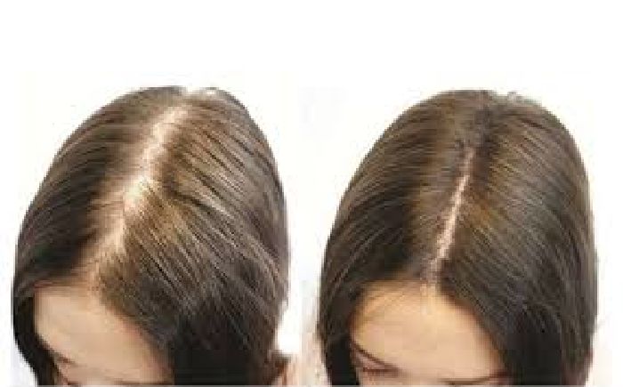 Điều trị hói đầu, rụng tóc