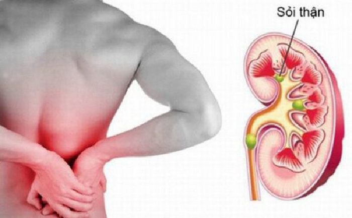 Phòng và trị bệnh sỏi thận