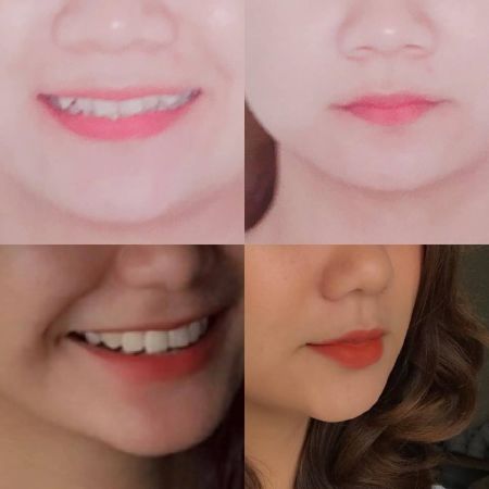 Thời gian tốt nhất để niềng răng là lúc nào?