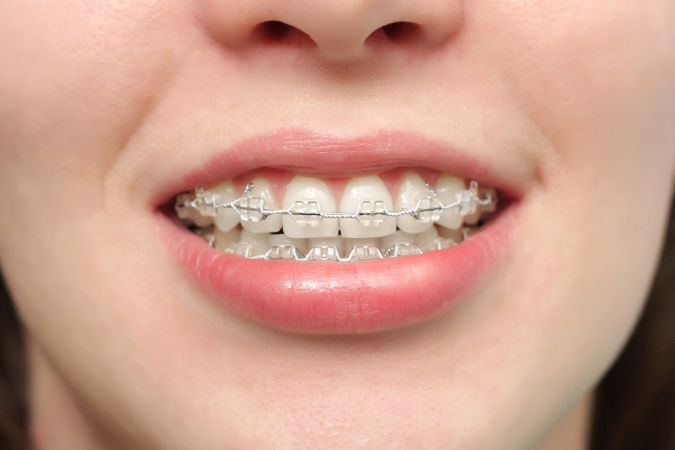 Giao tiếp khi niềng răng