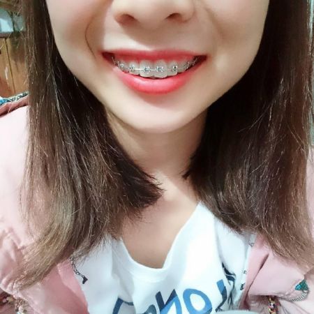 Niềng răng có đau hay không?