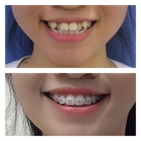 Niềng răng giá bao nhiêu tiền?