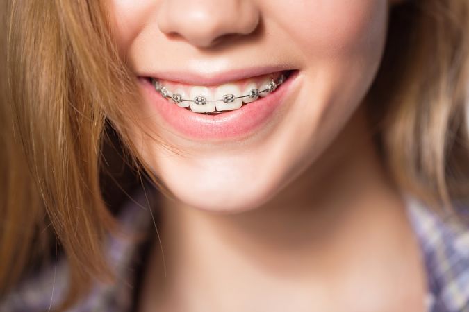 Sau khi niềng răng thì có cần chăm sóc hay lưu ý gì không?