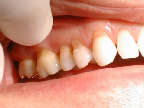Chữa viêm lợi chắc răng