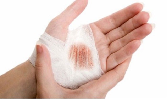 Cầm máu hiệu quả