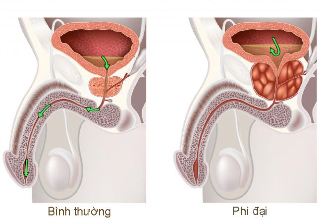 Giảm phì đại tuyến tiền liệt ở nam giới