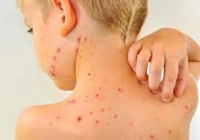 Trị đậu sởi không mọc