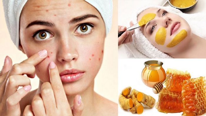Mật ong trị mụn