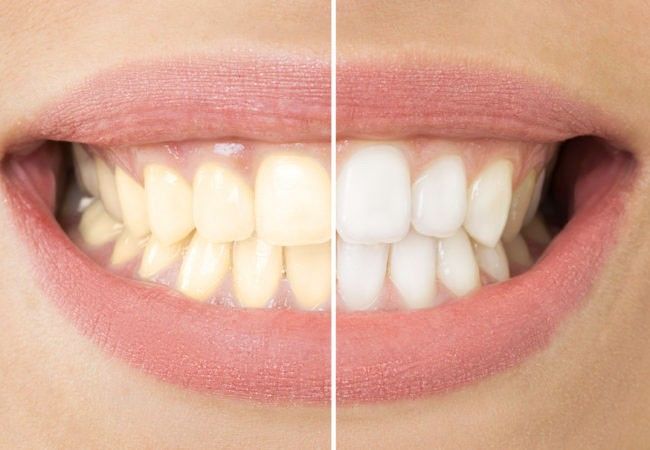 Răng bị đổi màu do độ tuổi của trẻ