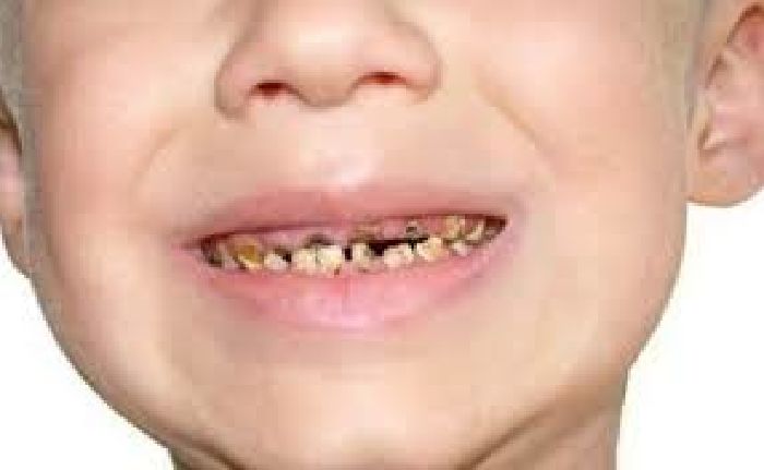 Răng trẻ bị đổi màu do thuốc