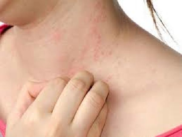 Hỗ trợ chữa các bệnh ngoài da