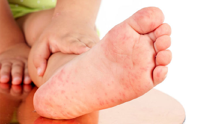 Chữa trị bắp chân, bàn chân bị lở loét