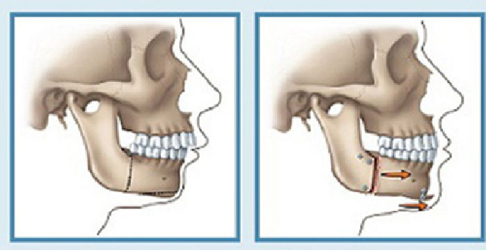 Phẫu thuật thẩm mỹ răng
