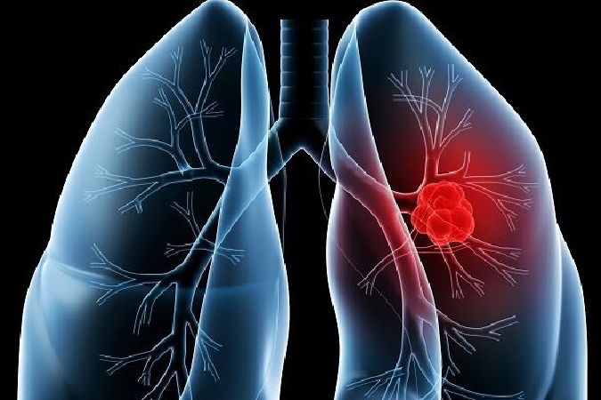Điều trị bệnh phổi