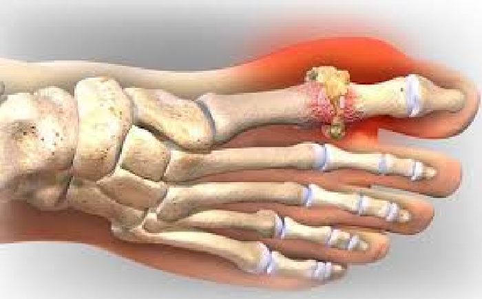 Loại bỏ axit uric và điều trị bệnh gout