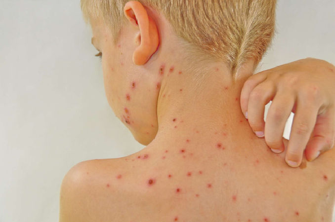 Làm dịu mẩn đỏ trên người