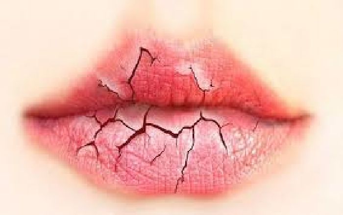 Trị hôi miệng, khô miệng