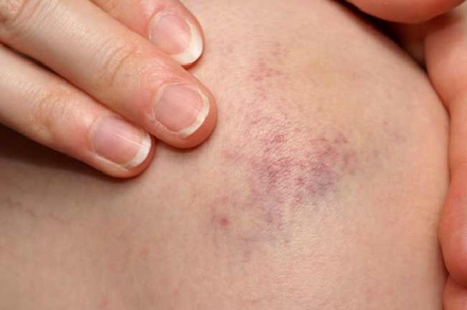 Cải thiện tình trạng bầm tím, ứ huyết trên da