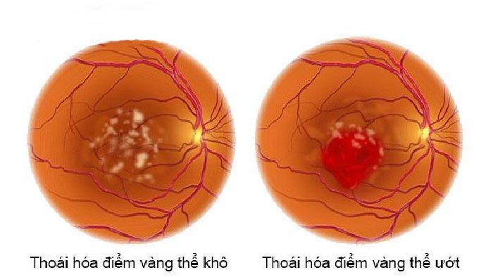 Ngăn ngừa thoái hóa điểm vàng