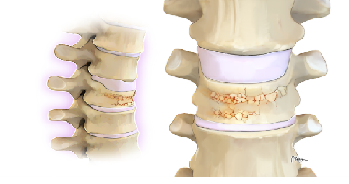 Tăng cường sức khỏe cho xương