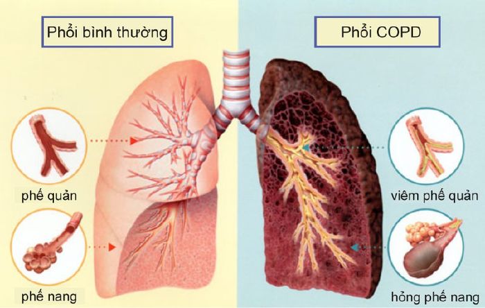 Bệnh lao phổi