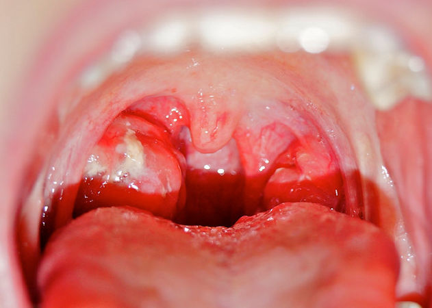 Bệnh viêm họng cấp