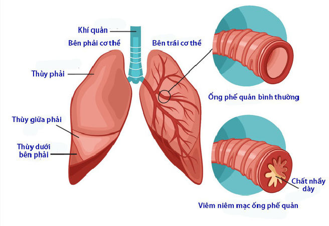 Viêm phế quản cấp, viêm khí quản