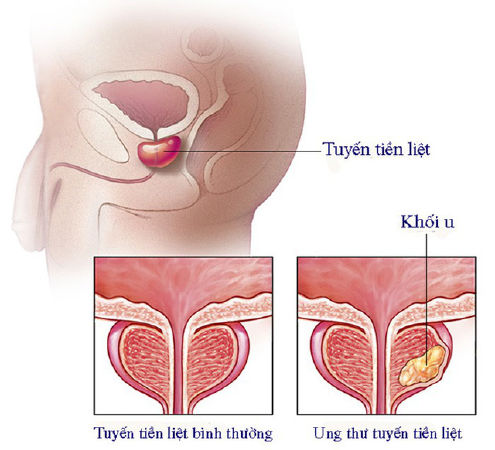 Ung thư tuyến tiền liệt