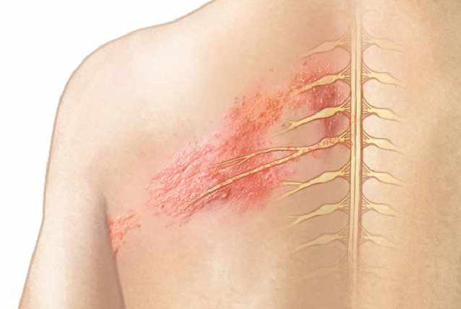 Bài thuốc trị mụn nhọt, ghẻ lở