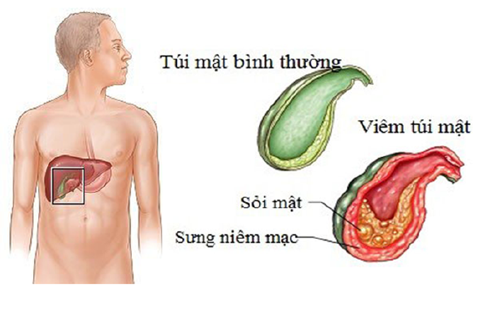 Bài thuốc trị sạn mật
