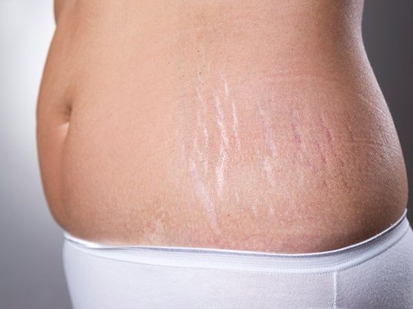 Sử dụng trị rạn da sau sinh