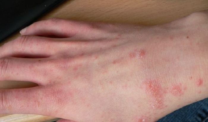 Cây bạch đàn trị bệnh ghẻ